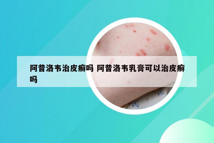 阿昔洛韦治皮癣吗 阿昔洛韦乳膏可以治皮癣吗