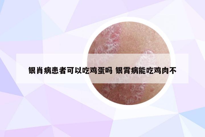 银肖病患者可以吃鸡蛋吗 银霄病能吃鸡肉不
