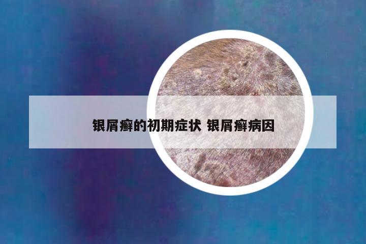 银屑癣的初期症状 银屑癣病因