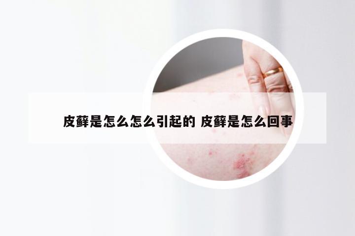 皮藓是怎么怎么引起的 皮藓是怎么回事
