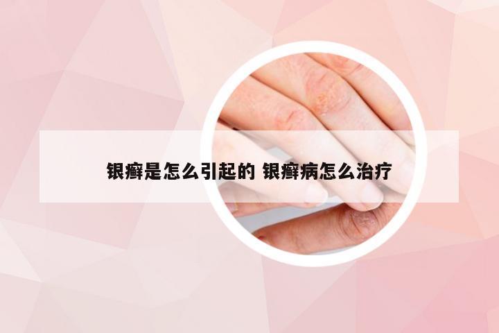 银癣是怎么引起的 银癣病怎么治疗