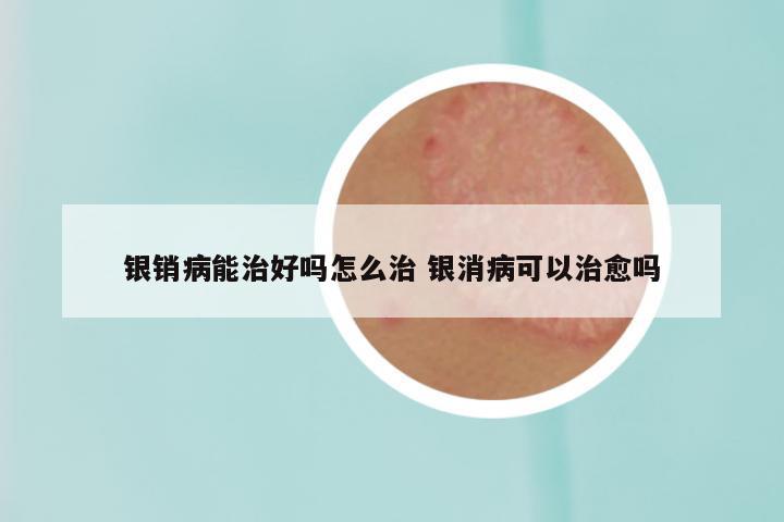 银销病能治好吗怎么治 银消病可以治愈吗