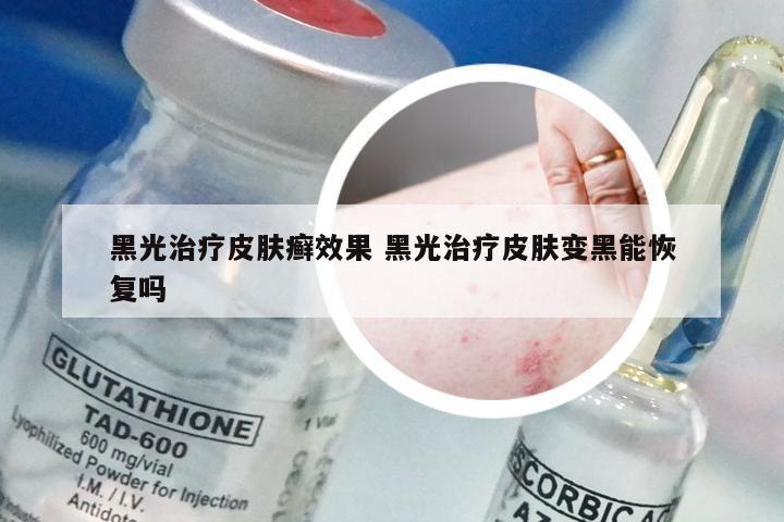 黑光治疗皮肤癣效果 黑光治疗皮肤变黑能恢复吗