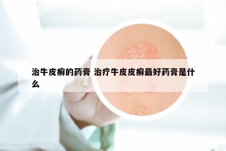 治牛皮癣的药膏 治疗牛皮皮癣最好药膏是什么