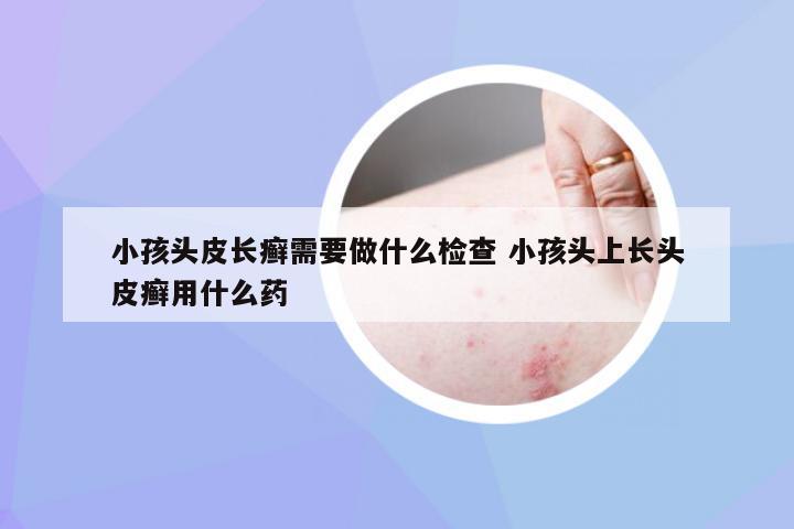 小孩头皮长癣需要做什么检查 小孩头上长头皮癣用什么药