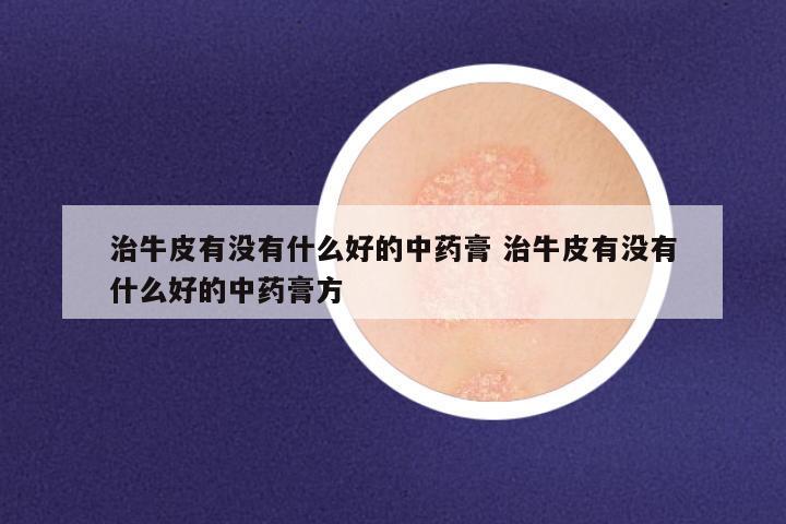 治牛皮有没有什么好的中药膏 治牛皮有没有什么好的中药膏方