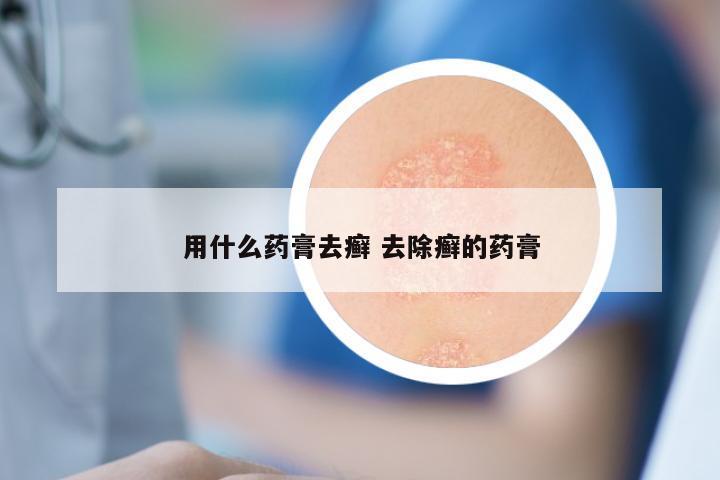 用什么药膏去癣 去除癣的药膏
