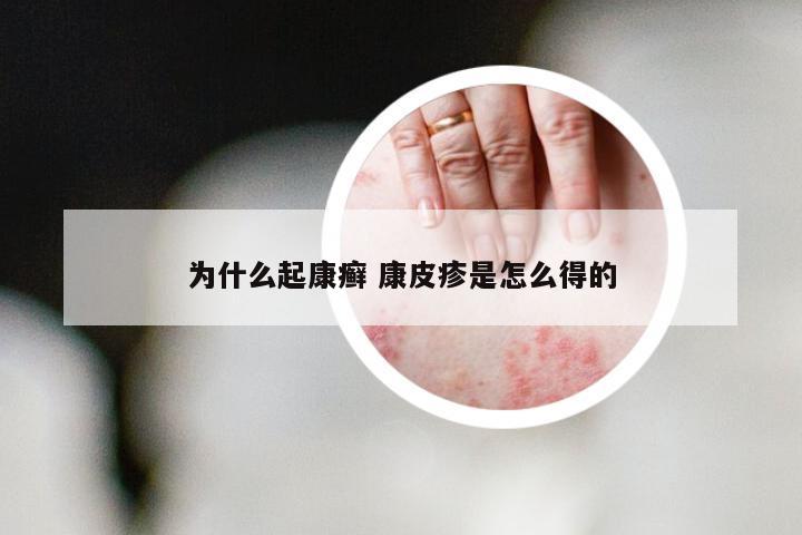 为什么起康癣 康皮疹是怎么得的