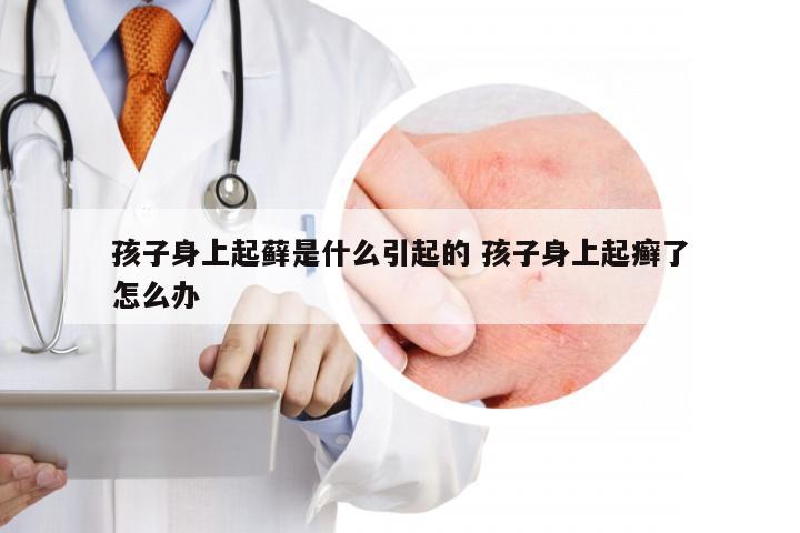 孩子身上起藓是什么引起的 孩子身上起癣了怎么办