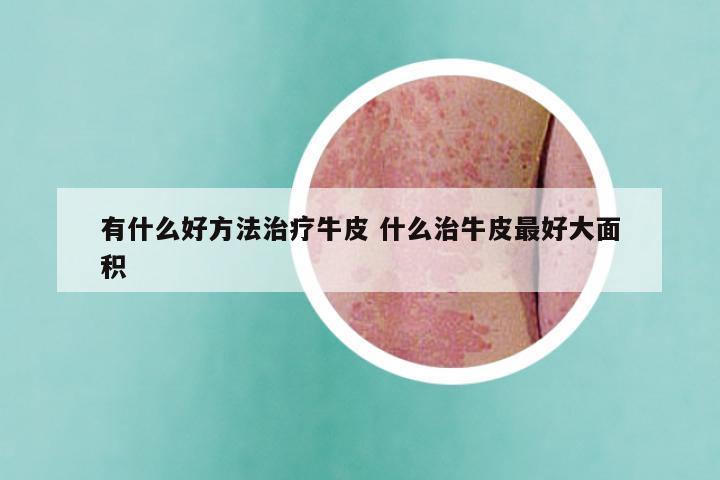 有什么好方法治疗牛皮 什么治牛皮最好大面积