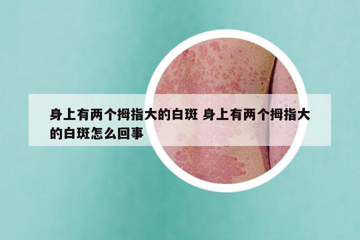 身上有两个拇指大的白斑 身上有两个拇指大的白斑怎么回事