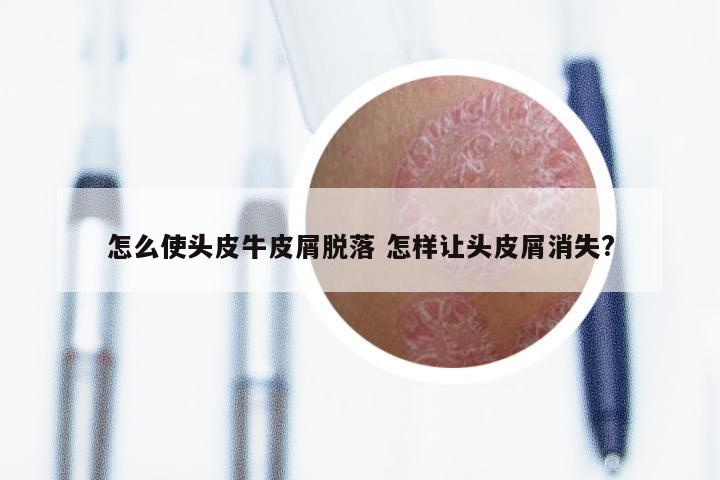 怎么使头皮牛皮屑脱落 怎样让头皮屑消失?