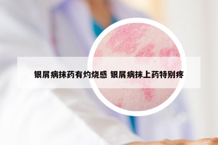银屑病抹药有灼烧感 银屑病抹上药特别疼