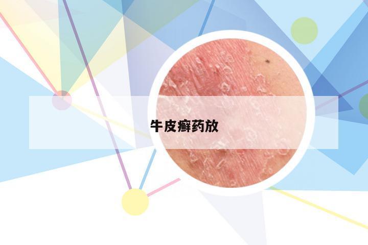 牛皮癣药放