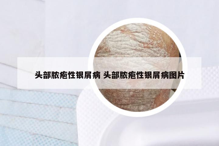 头部脓疱性银屑病 头部脓疱性银屑病图片