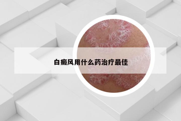 白癜风用什么药治疗最佳