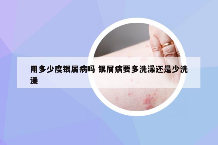 用多少度银屑病吗 银屑病要多洗澡还是少洗澡