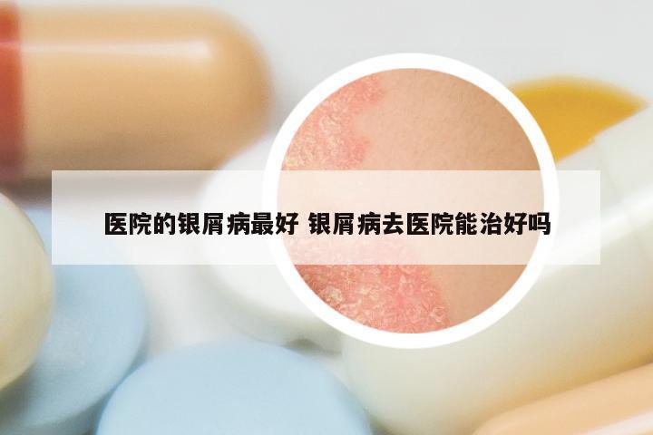医院的银屑病最好 银屑病去医院能治好吗