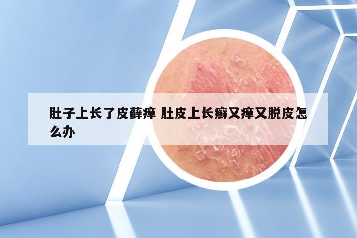 肚子上长了皮藓痒 肚皮上长癣又痒又脱皮怎么办