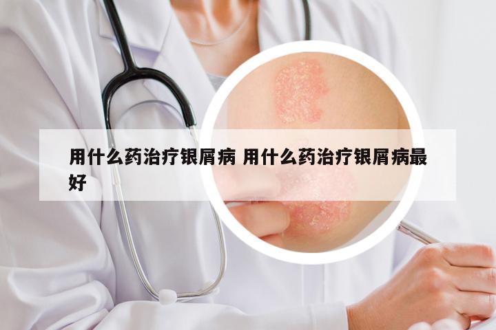 用什么药治疗银屑病 用什么药治疗银屑病最好