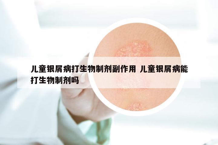 儿童银屑病打生物制剂副作用 儿童银屑病能打生物制剂吗