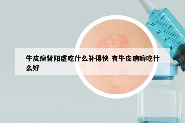 牛皮癣肾阳虚吃什么补得快 有牛皮病癣吃什么好