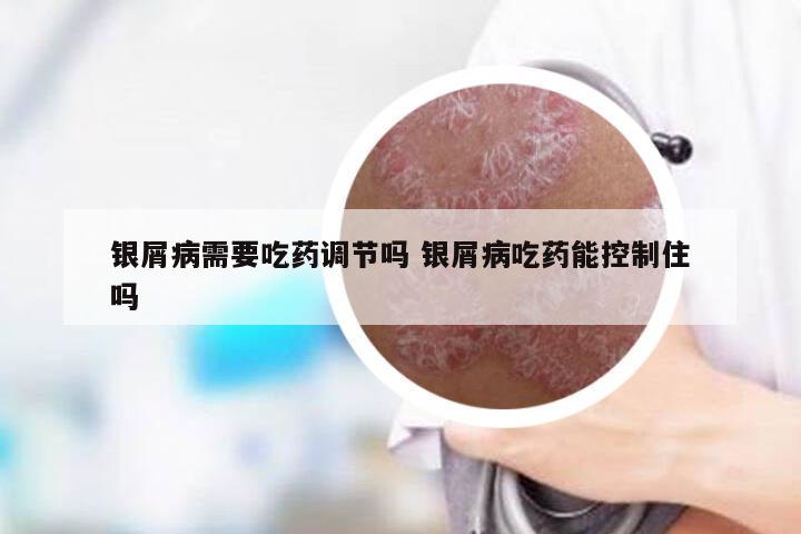 银屑病需要吃药调节吗 银屑病吃药能控制住吗