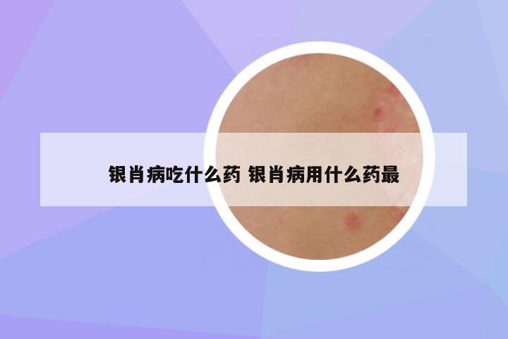 银肖病吃什么药 银肖病用什么药最