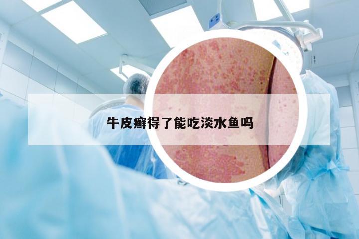 牛皮癣得了能吃淡水鱼吗