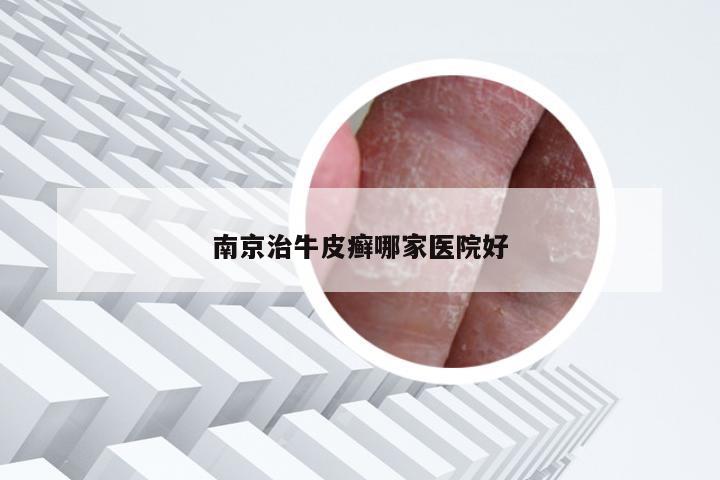 南京治牛皮癣哪家医院好