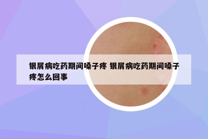 银屑病吃药期间嗓子疼 银屑病吃药期间嗓子疼怎么回事