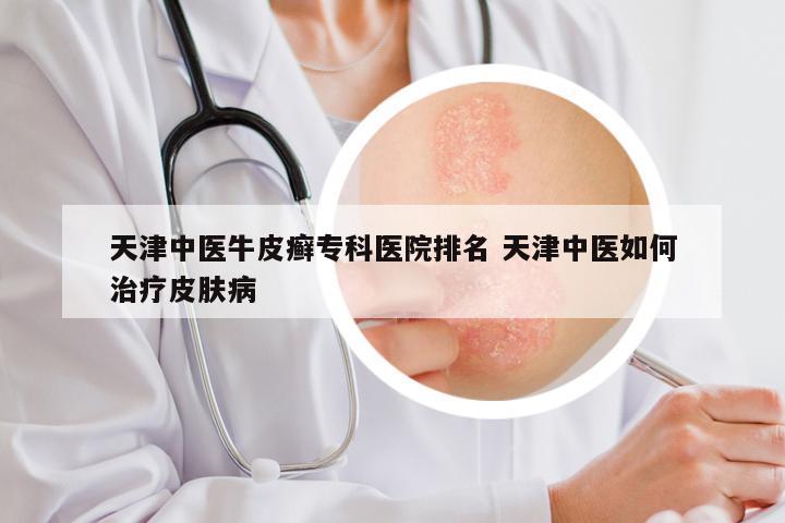天津中医牛皮癣专科医院排名 天津中医如何治疗皮肤病