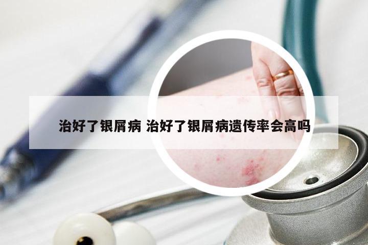 治好了银屑病 治好了银屑病遗传率会高吗
