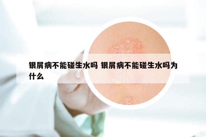 银屑病不能碰生水吗 银屑病不能碰生水吗为什么
