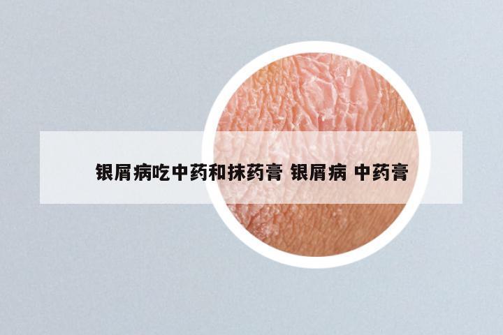 银屑病吃中药和抹药膏 银屑病 中药膏