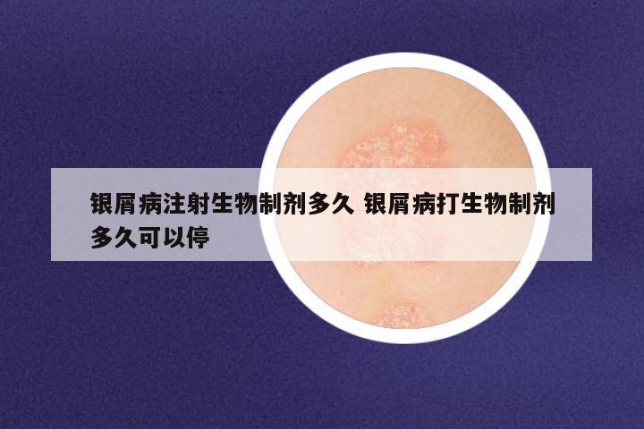 银屑病注射生物制剂多久 银屑病打生物制剂多久可以停