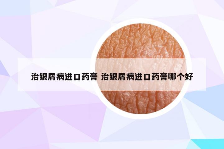 治银屑病进口药膏 治银屑病进口药膏哪个好