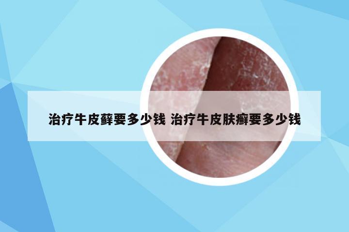 治疗牛皮藓要多少钱 治疗牛皮肤癣要多少钱