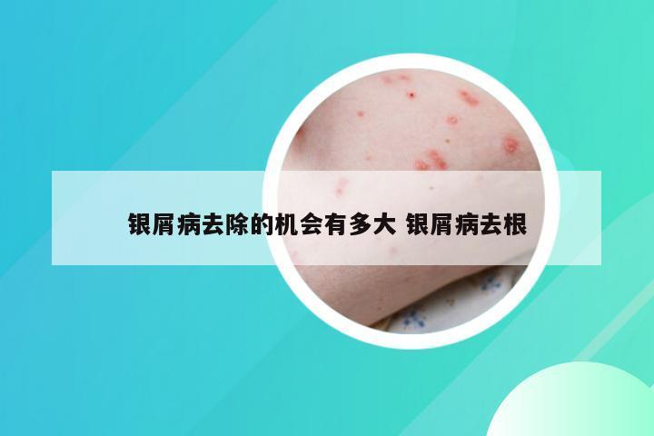 银屑病去除的机会有多大 银屑病去根