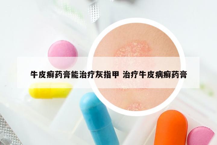 牛皮癣药膏能治疗灰指甲 治疗牛皮病癣药膏