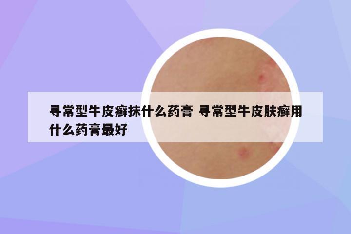 寻常型牛皮癣抹什么药膏 寻常型牛皮肤癣用什么药膏最好