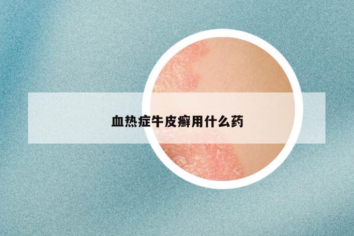 血热症牛皮癣用什么药