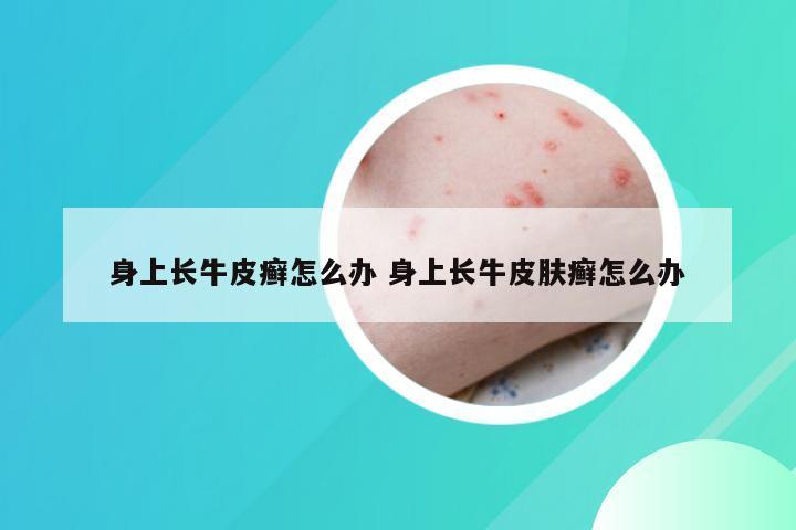 身上长牛皮癣怎么办 身上长牛皮肤癣怎么办