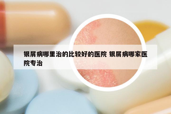 银屑病哪里治的比较好的医院 银屑病哪家医院专治