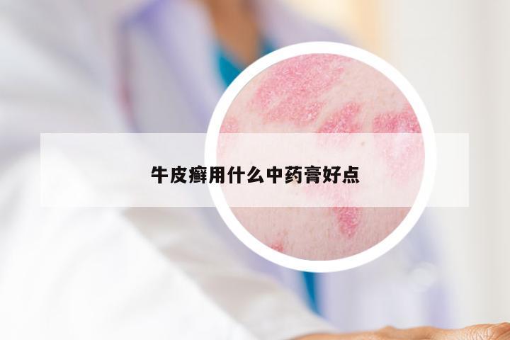 牛皮癣用什么中药膏好点