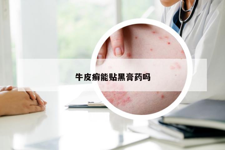 牛皮癣能贴黑膏药吗