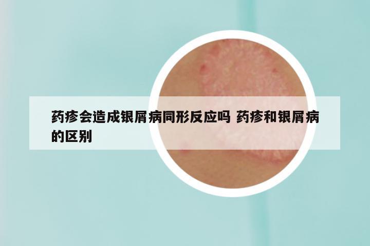 药疹会造成银屑病同形反应吗 药疹和银屑病的区别