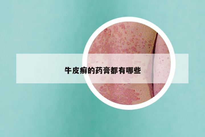 牛皮癣的药膏都有哪些