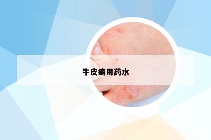 牛皮癣用药水
