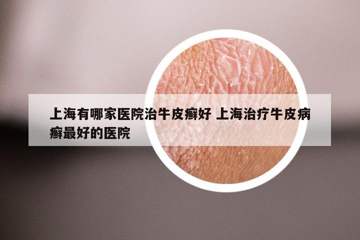上海有哪家医院治牛皮癣好 上海治疗牛皮病癣最好的医院